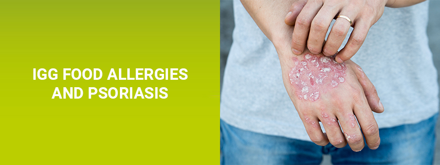 Psoriasis – an inflammatory skin disease